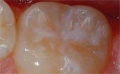 Sealant After